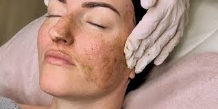 Abonnement behandeling A